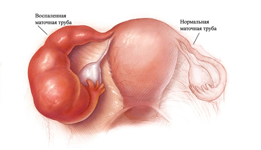  воспаление матки и придатков при микоплазмозе 
