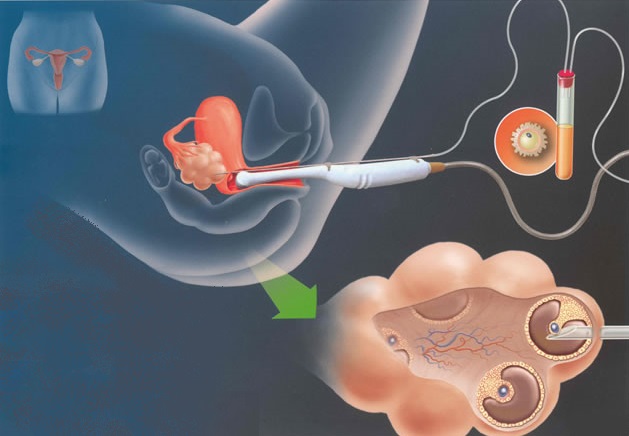 ¿Qué es y en qué consiste la inseminación artificial?