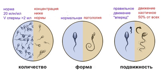 Гипоплазия яичек. Что такое Гипоплазия яичек?